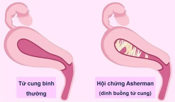 Dính buồng tử cung (Hội chứng Asherman): Nguyên nhân cản trở phôi thai làm tổ