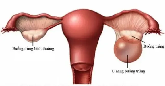 U nang buồng trứng: Dấu hiệu và khi nào cần mổ?