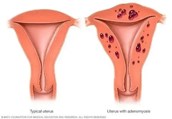 Adenomyosis: Dấu hiệu, điều trị và khả năng mang thai