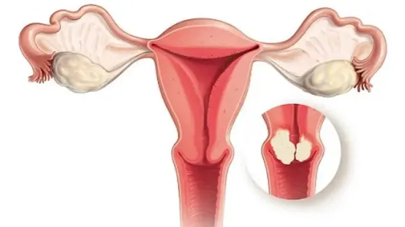 Polyp nội mạc tử cung: Dấu hiệu và khi nào cần cắt?