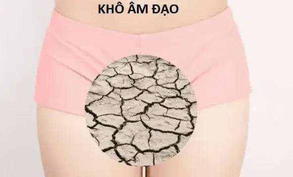Khô âm đạo: Nguyên nhân và cách cải thiện an toàn