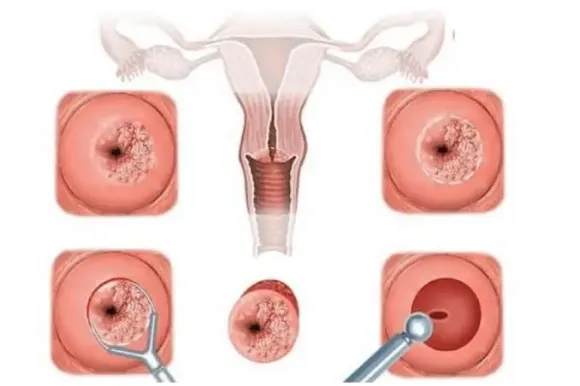 Viêm cổ tử cung: Dấu hiệu và cách điều trị phù hợp