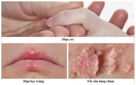 Xét nghiệm HPV, Pap và soi cổ tử cung khác nhau thế nào?