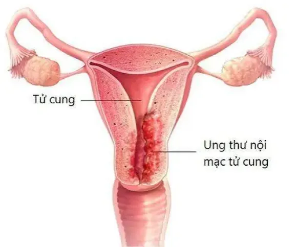 Nội mạc tử cung dày có phải ung thư? Khi nào sinh thiết?