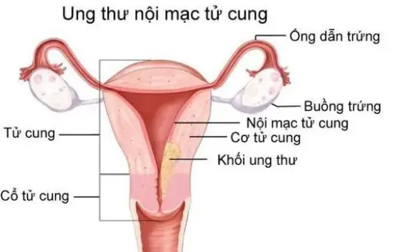 Ung thư nội mạc tử cung: Dấu hiệu sớm cần biết