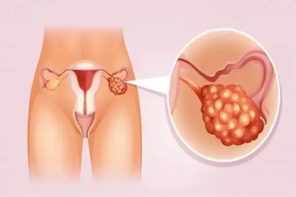 Điều trị ung thư buồng trứng: Mổ trước hay hóa trị trước?