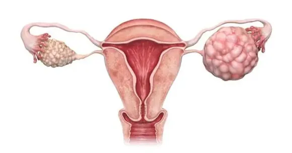 Ung thư vòi trứng: Dấu hiệu, chẩn đoán và điều trị