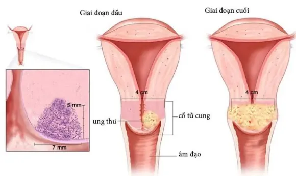 Chăm sóc sau điều trị ung thư cổ tử cung đúng cách