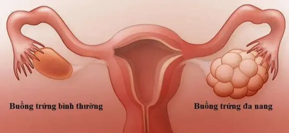 Hội chứng buồng trứng đa nang (PCOS) - Kẻ thù của sức khỏe sinh sản