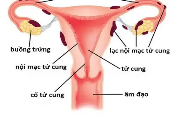 Lạc nội mạc tử cung: Nỗi ám ảnh 