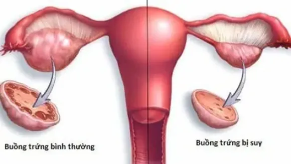Suy buồng trứng sớm: Khi đồng hồ sinh học 
