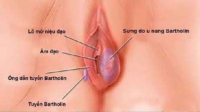 Nang tuyến Bartholin: Dấu hiệu và cách điều trị