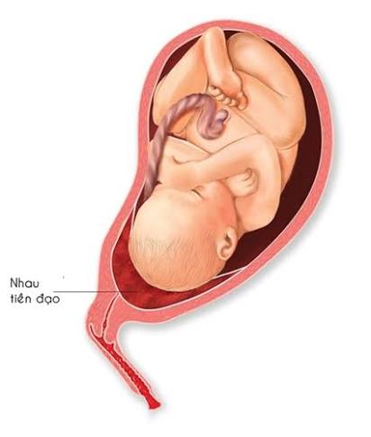 Nhau tiền đạo: Nguyên nhân, triệu chứng và lưu ý khi mang thai tháng cuối